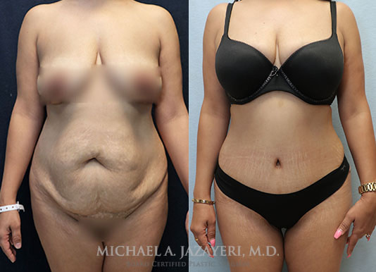 Tummy Tuck Before & After Photos