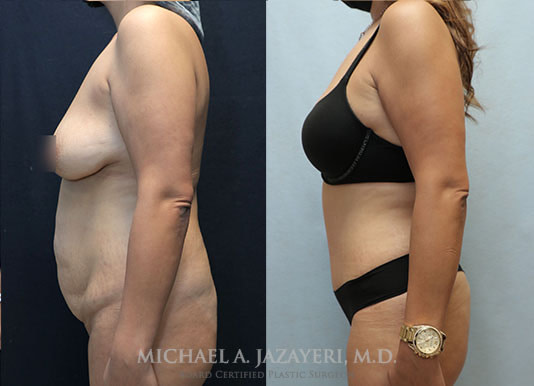 Tummy Tuck Before & After Photos