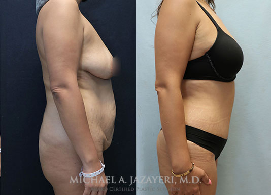 Tummy Tuck Before & After Photos