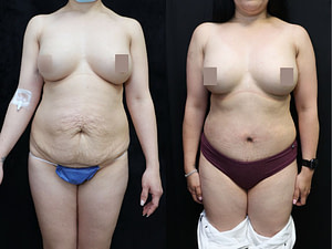 Tummy Tuck Before & After Photos