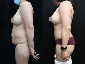 Tummy Tuck Before & After Photos