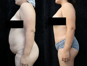 abdominoplasty left before and after