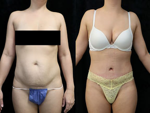 tummy tuck front