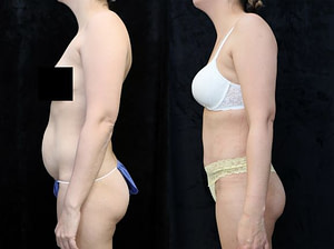 tummy tuck left