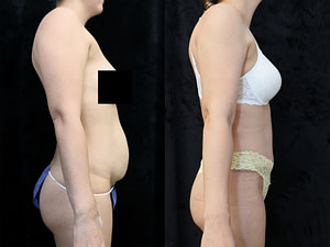 tummy tuck right