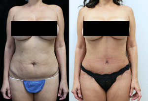 abdominoplasty before and after photos