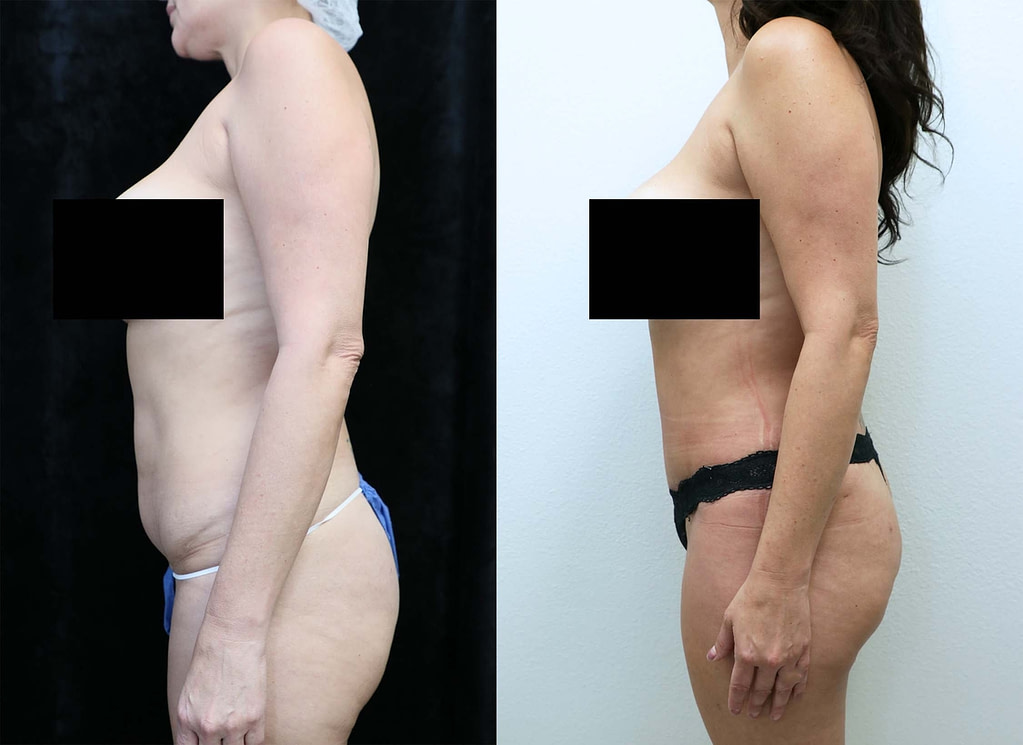 abdominoplasty before and after photos left