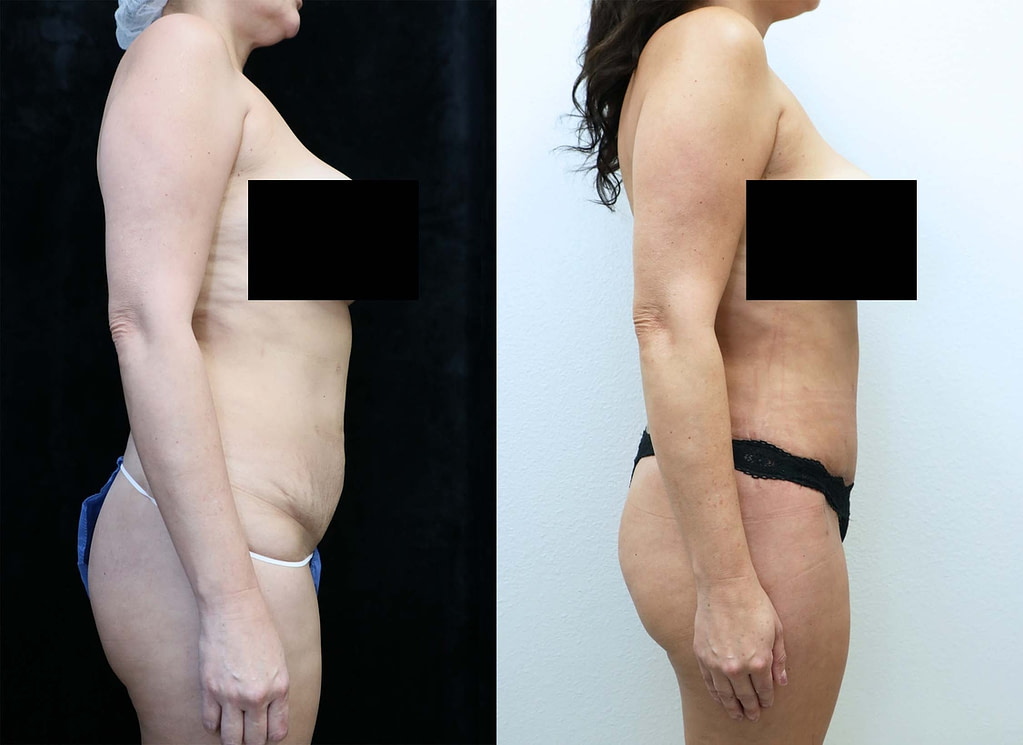 abdominoplasty before and after photos