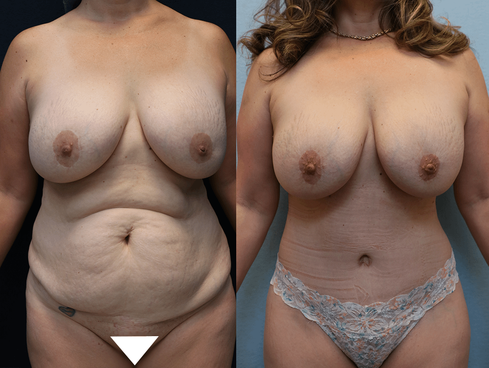 Tummy Tuck