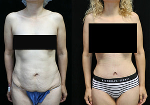 tummy tuck orange county before and after
