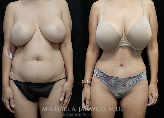 abdominoplasty before and after front