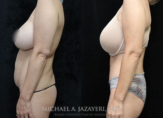 abdominoplasty before and after left