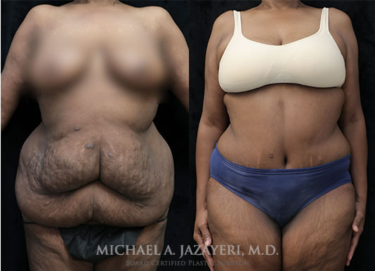 tummy tuck before and after front