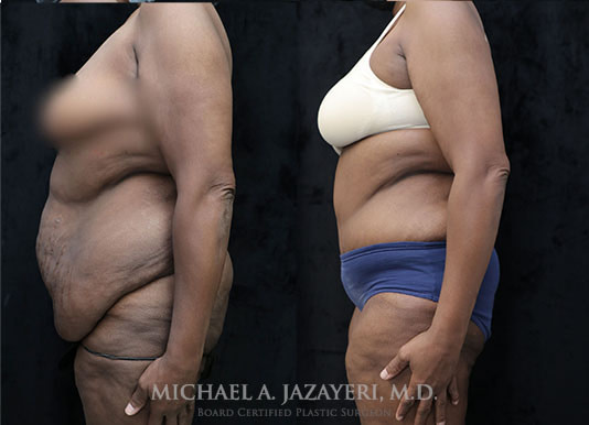 tummy tuck before and after left