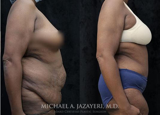 tummy tuck before and after right