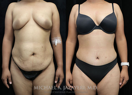 abdominoplasty before and after