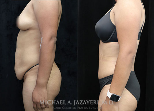 abdominoplasty before and after