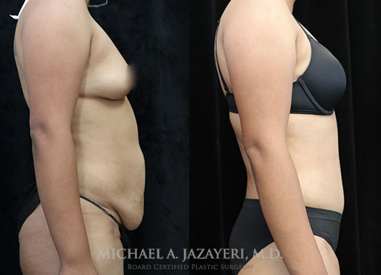 abdominoplasty before and after