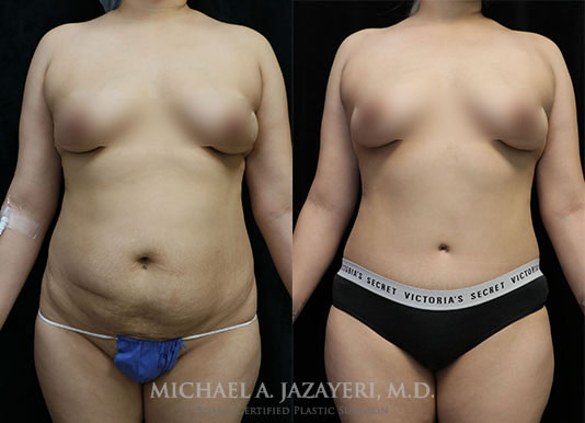 tummy tuck before and after results front
