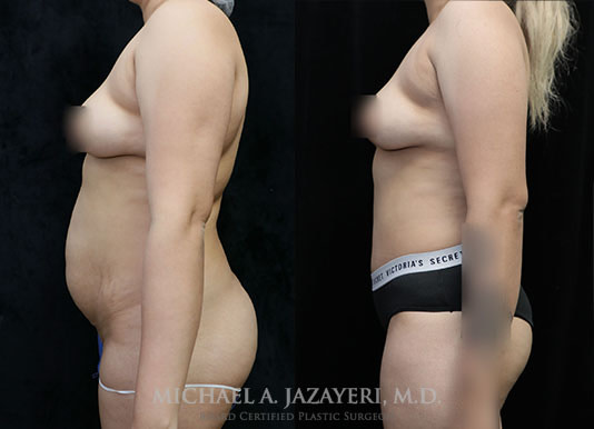tummy tuck before and after results left
