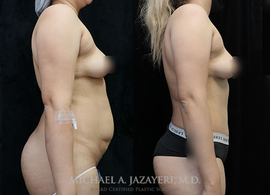 tummy tuck before and after results right