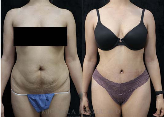 abdominoplasty before and after