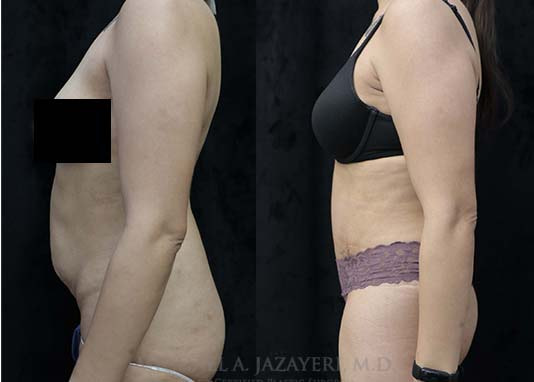 abdominoplasty before and after