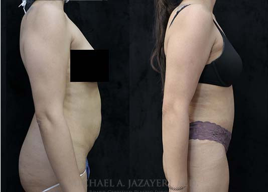 tummy tuck before and after
