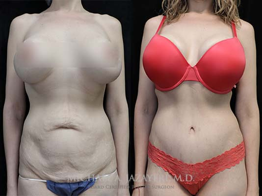 tummy tuck before and after results front