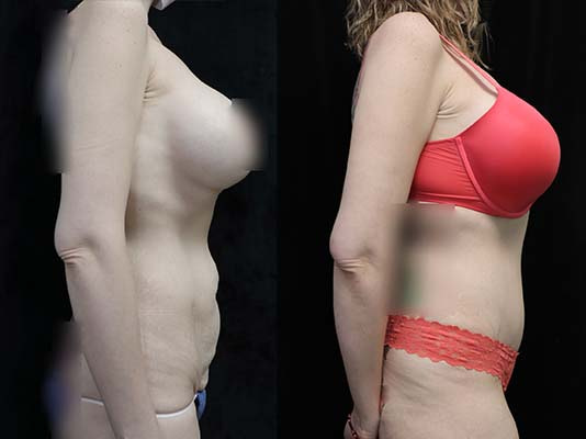 tummy tuck before and after results right