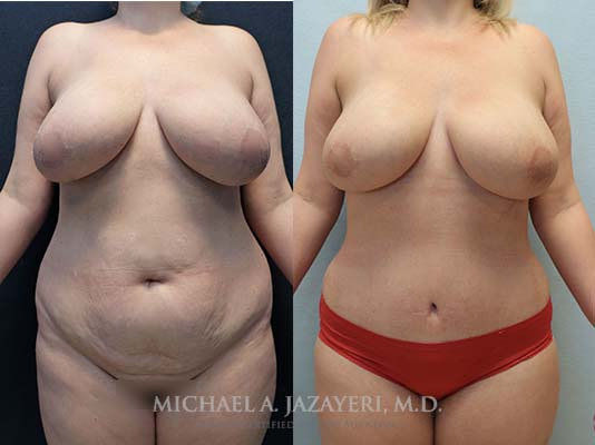 abdominoplasty before and after front result after 2 months