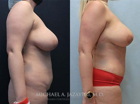 abdominoplasty before and after result after 2 months