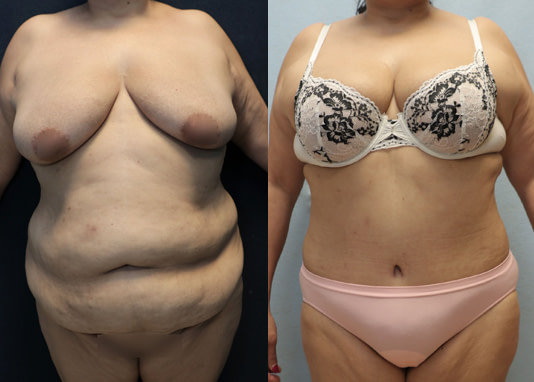 tummy tuck front before after result after 4 months