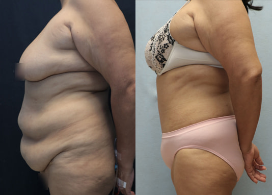 tummy tuck left before after result after 4 months