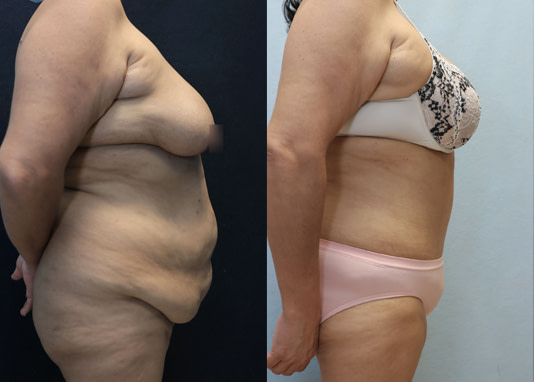 tummy tuck right before after result after 4 months