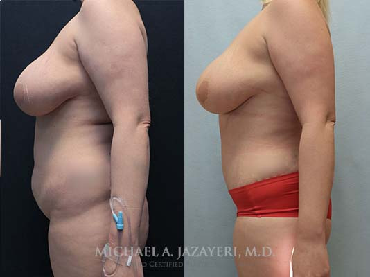 abdominoplasty before and after result after 2 months