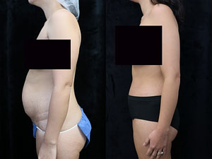 left side photos tummy tuck