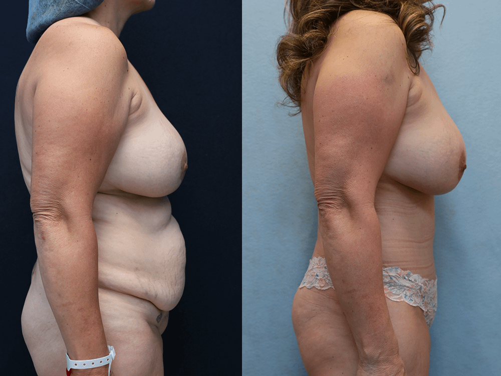 Tummy Tuck