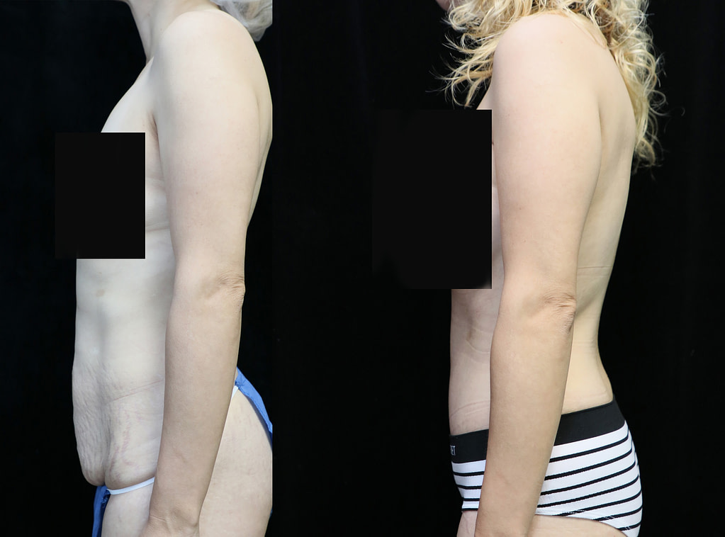 tummy tuck in orange county CA