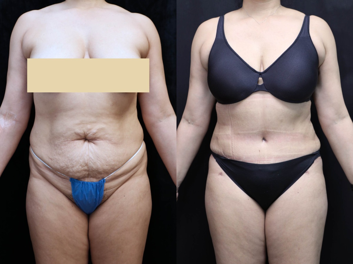 Tummy Tuck Results Oranage County  Santa Ana