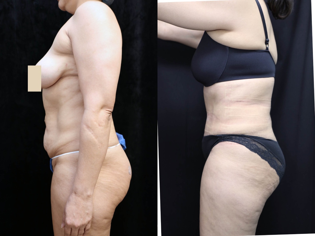 Tummy Tuck Results Oranage County  Santa Ana