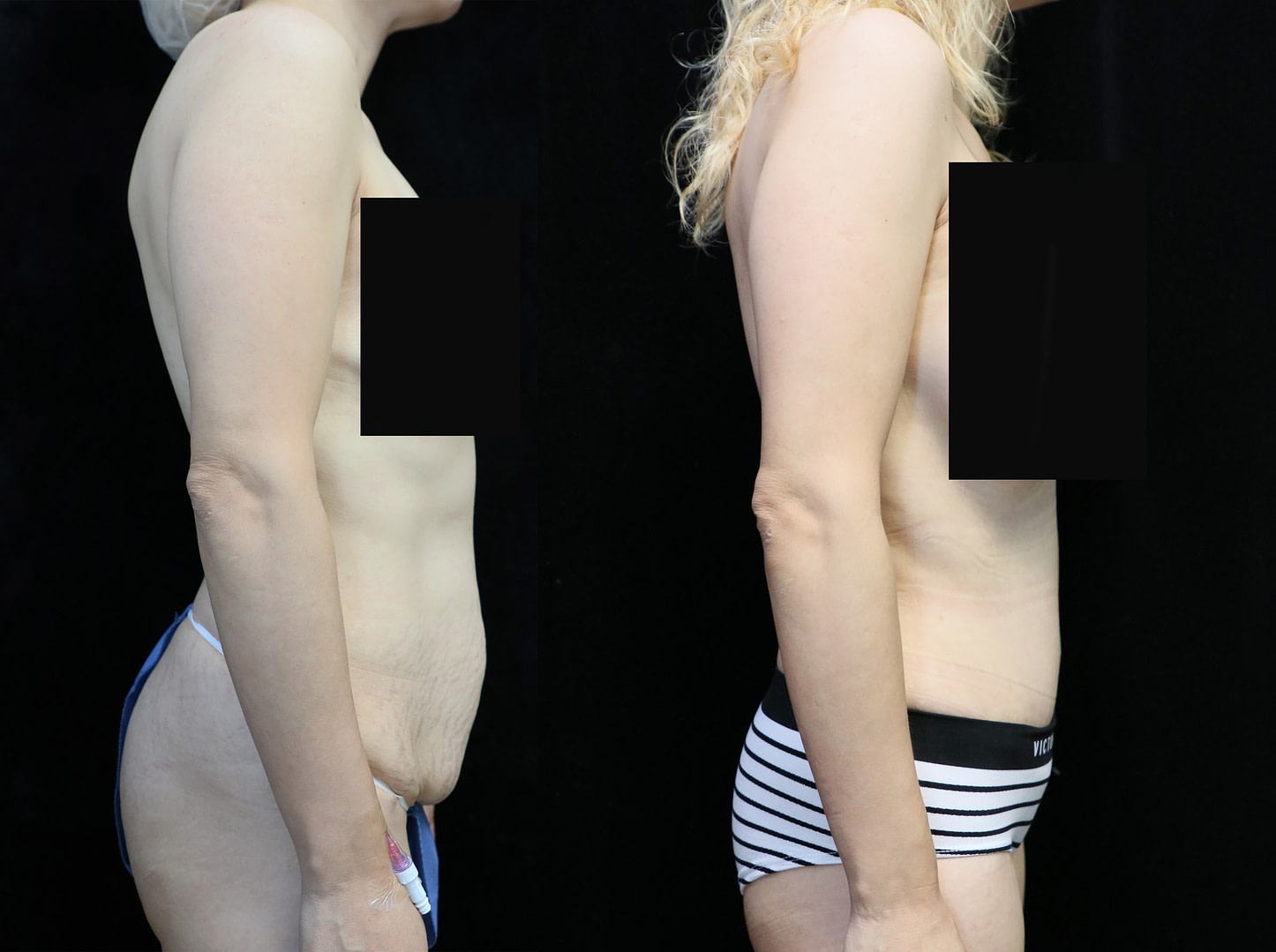 tummy tuck in orange county CA