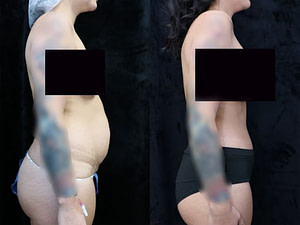 right side photos tummy tuck