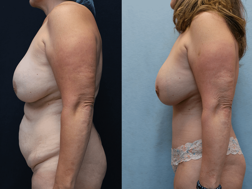 Tummy Tuck