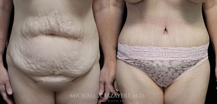 Tummy Tuck Before & After Photos