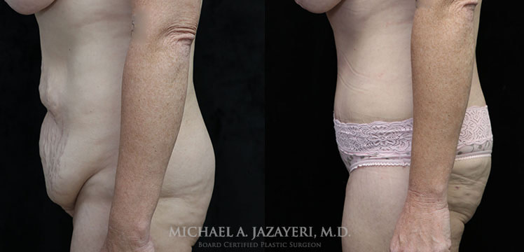 mini abdominoplasty and liposuction of flanks before and after