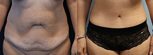 Tummy Tuck
